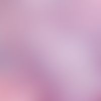 Immunrekonstitutions-Follikulitis:&nbsp;gemischtezllige, überwiegend neutrophile Follikulitis, we...