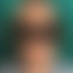 Griscelli-Syndrom Typ 3: bei einer indischen Patientin. Helle Haut mit grau-blondem Haar. Abb. en...