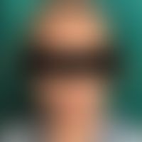 Griscelli-Syndrom Typ 3: bei einer indischen Patientin. Helle Haut mit grau-blondem Haar. Abb. en...