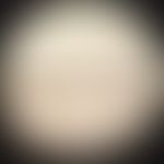 Griscelli-Syndrom Typ 3: unförmige Melaninschollen&nbsp;in einem Haarschaft. Abb. entnommen aus: ...
