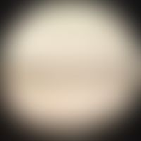 Griscelli-Syndrom Typ 3: unförmige Melaninschollen&nbsp;in einem Haarschaft. Abb. entnommen aus: ...