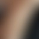 Pseudoxanthoma elasticum: 67jährige Patientin. Die streifigen gelblichen Hautveränderungen finden...