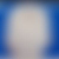 Albinismus okulokutaner:&nbsp;silberweißes Haar bei Okulokutanem Albinimus Typ 1 (OCA1). Abb. ent...