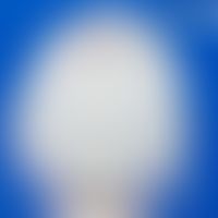 Albinismus okulokutaner:&nbsp;silberweißes Haar bei Okulokutanem Albinimus Typ 1 (OCA1). Abb. ent...