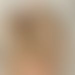 Differenzialdiagnose&nbsp;Albinismus okulokutaner: Chinesische Patientin mit Hermansky-Pudlak-Syn...
