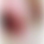 Wiesner Nävus (BAP1-mutierter Nävus): Kann Teilsymptom eines&nbsp;genetisches Tumorprädisposition...