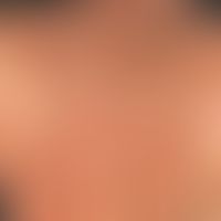 Tinea corporis:&nbsp;Großflächige, rötlich-bräunliche, randbetonte Herde im Bereich des Rückens, ...