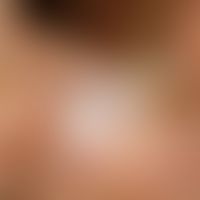 Tinea pedum:&nbsp;Mazerierte, weißliche, aufgequollene Haut sowie kleine Erosionen im 1. Zwischen...