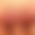 Tinea corporis (Tinea profunda): seit Monaten bestehender und langsam progredienter, juckender un...