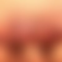 Tinea corporis (Tinea profunda): seit Monaten bestehender und langsam progredienter, juckender un...