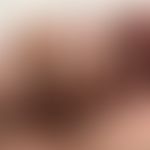 Kleines Hämatom am Ringfinger bei bekannter Thrombozythämie

