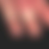 Daktylitis: schwere Daktylitis bei bekannter Psoriasis (pustulosa)&nbsp;
