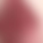Arthritis urica:&nbsp;identischer Patient wie in Abbn. 1+2. Plötzlich aufgetretene, schmerzhafte&...