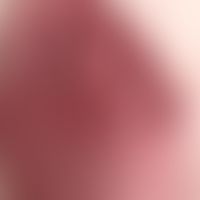 Arthritis urica:&nbsp;identischer Patient wie in Abbn. 1+2. Plötzlich aufgetretene, schmerzhafte&...