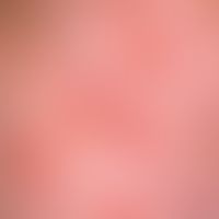 Pityriasis rosea:&nbsp;Collerette-Schuppung: Für die Pityriasis rosea typische Art der Schuppung ...