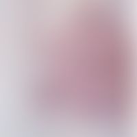 Zoster (Herpes zoster): frische Infektion mit segementalem Befallsmuster. Gruppierte und konfluie...