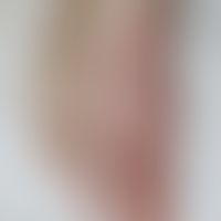 Tinea incognita:&nbsp;Randbetonte, psoriasiforme Plaques die mit einem Kortikoid-haltigen, antips...