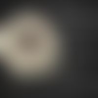 3D-Moulage "Superfiziell spreitendes Malignes Melanom".&nbsp;Moulage von R. Willi aus dem Moulage...