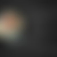 3D-Moulage "Rhinophym. "Moulage von R. Willi aus dem Moulagenmuseum der Universität Zürich im VIM...