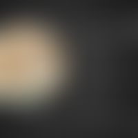 3D-Moulage "Urtikaria".&nbsp;Moulage von Elsbeth Stoiber aus dem Moulagenmuseum der Universität Z...