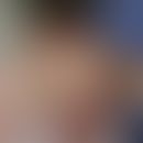 Arzneimittel-induzierter Lupus erythematodes: teil nummuläre, teils auch anuläre sukkulente, rote...