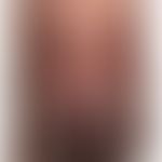 Tinea corporis: Ausgedehnte Dermatophyteninfektion (T.indotineae) bei einem indischen Patienten. ...