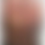 Tinea corporis: Ausgedehnte Dermatophyteninfektion (T.indotineae) bei einem indischen Patienten. ...