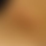 Cimikose (Wanzenstiche):&nbsp;multiple, gruppierte,&nbsp; hautfarbene, urtikarielle Papeln und Pl...