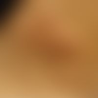 Cimikose (Wanzenstiche):&nbsp;multiple, gruppierte,&nbsp; hautfarbene, urtikarielle Papeln und Pl...