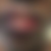 Reaktive infektiöse mukokutane Eruption: massive&nbsp; verkrustete Schleimhauterosionen. Abb. ent...