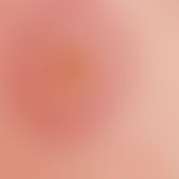 Erythema multiforme: Darstellung einer typischen Kokarde. Abb. entnommen aus:&nbsp;

https://www2...