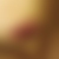 Reaktive infektiöse mukokutane Eruption:&nbsp;nachgewiesene Infektion mit Mycoplasma pneumoniae. ...