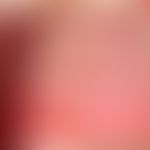 Fuchs-Syndrom (als Minusvariante des EM-majus): anuläre, mehrzonige mukosale Läsionen. Daneben fl...