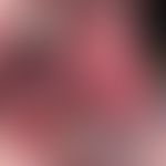 Erythema multiforme majus als Frühform einer Covid-19-Infektion. flächenhafte Erosionen an Zunge ...