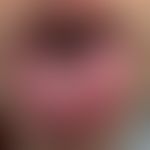 Erythema multiforme majus als Frühform einer Covid-19-Infektion. Bizarre aphthöse Defekte der Zun...