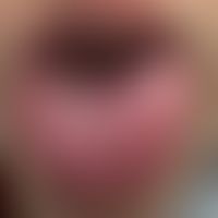 Erythema multiforme majus als Frühform einer Covid-19-Infektion. Bizarre aphthöse Defekte der Zun...