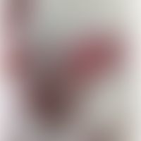 IgA-Pemphigus:&nbsp;flächige, teils&nbsp;reepithelisierte schmerzhafte Erosionen S.unter Fallberi...