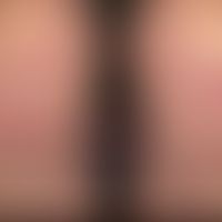 Dermatitis herpetiformis:&nbsp;Gruppierte,&nbsp;erodierte und Papeln (Vesikeln hier nicht nachwei...