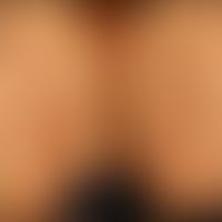 Dermatitis herpetiformis:&nbsp;Gruppierte,&nbsp;erodierte und Papeln (Vesikeln hier nicht nachwei...