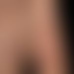 Pemphigus vulgaris: Extremitäten-betonte Blasen-bildende Erkrankung unter einer Tehrapie mit Immu...
