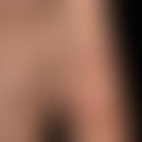 Pemphigus vulgaris: Extremitäten-betonte Blasen-bildende Erkrankung unter einer Tehrapie mit Immu...