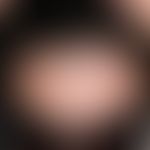 Spitzer Haaransatz:&nbsp;Abb. entnommen aus:https://de.wikipedia.org/wiki/Datei:Widows_peak_01. B...