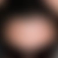 Spitzer Haaransatz:&nbsp;Abb. entnommen aus:https://de.wikipedia.org/wiki/Datei:Widows_peak_01. B...