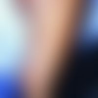 Rattenbissfieber: klein-makulo-papulöses, hämorrhagisches Exanthem, vereinzelt keline Bläschen. A...