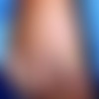 Rattenbissfieber: dichtes hämorrhagisches makulo-papulöses Exanthem. Abb. entnommen aus: Elliott ...