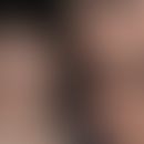 Prurigo aktinische: Familiäre aktisnicihe Prurigo mit juckenden, zerkratzten Papeln in sonnenexpo...