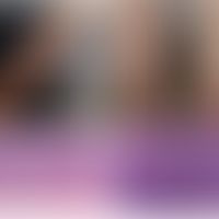 Lymphomatoide Papulose, EBV-induzierte:&nbsp;disseminierte Aussaat kleiner rot-brauner Knoten. Di...