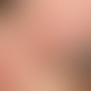 Miliaria-artiges primär kutanes Follikelzentrums-Lymphom: glasige gruppierte asympotmatische Knöt...