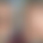 Pili torti: S.u. Fallbericht. Abb.entnommen aus:&nbsp;Davis CT et al. (2023)

