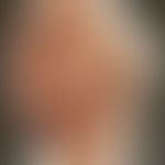 Syphilid papulöses: Historische Moulage. Abbildung entnommen aus: K. Zieler, Atlas der Haut- und ...